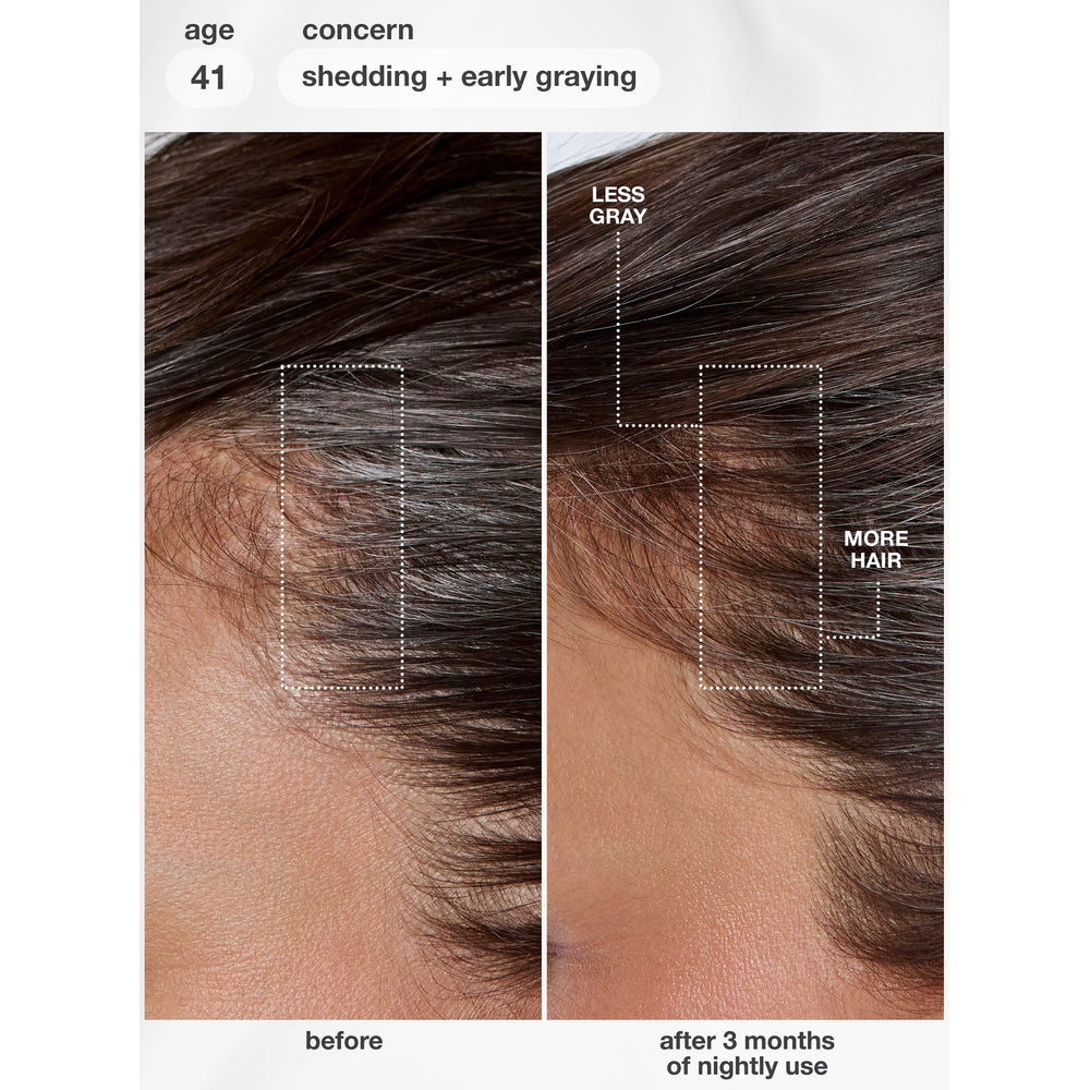 K18 FutureIQ Hair Longevity Serum before and after 3 months of nightly use for shedding and early greying, age 41