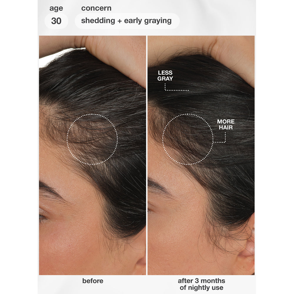 K18 FutureIQ Hair Longevity Serum before and after 3 months of nightly use for shedding and early greying, age 30