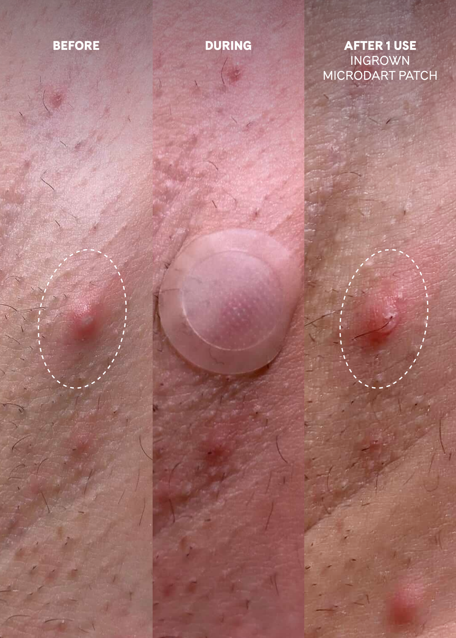 Fur Ingrown Microdart Patch before and after ingrown results